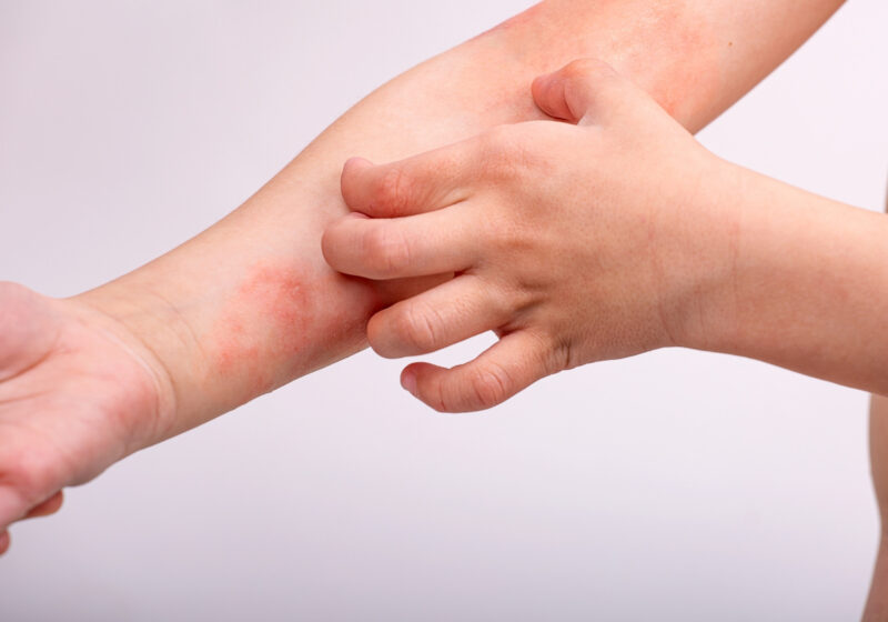 bambino con dermatite atopica sul braccio